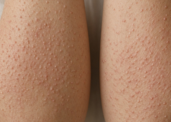 Hands showing Keratosis Pilaris.